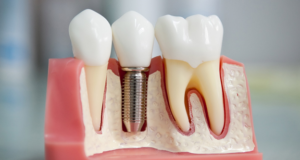 Виды и методы имплантации зубов